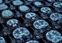 Nuevos fármacos contra el Alzheimer no muestran beneficios clínicos significativos, según revisión