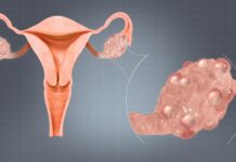 Estudio analiza si el síndrome de ovario poliquístico podría extender la fertilidad femenina